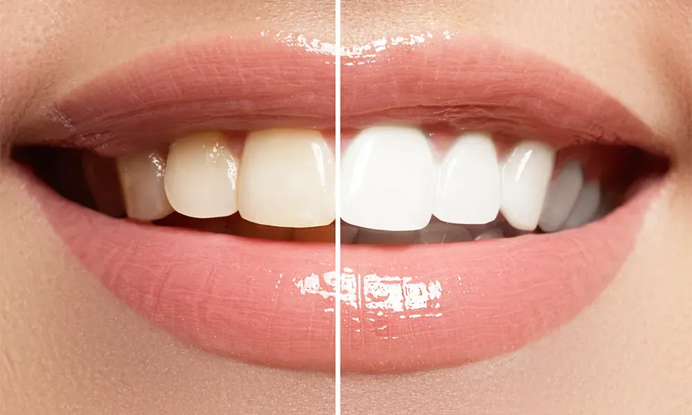KöR Whitening Treatment