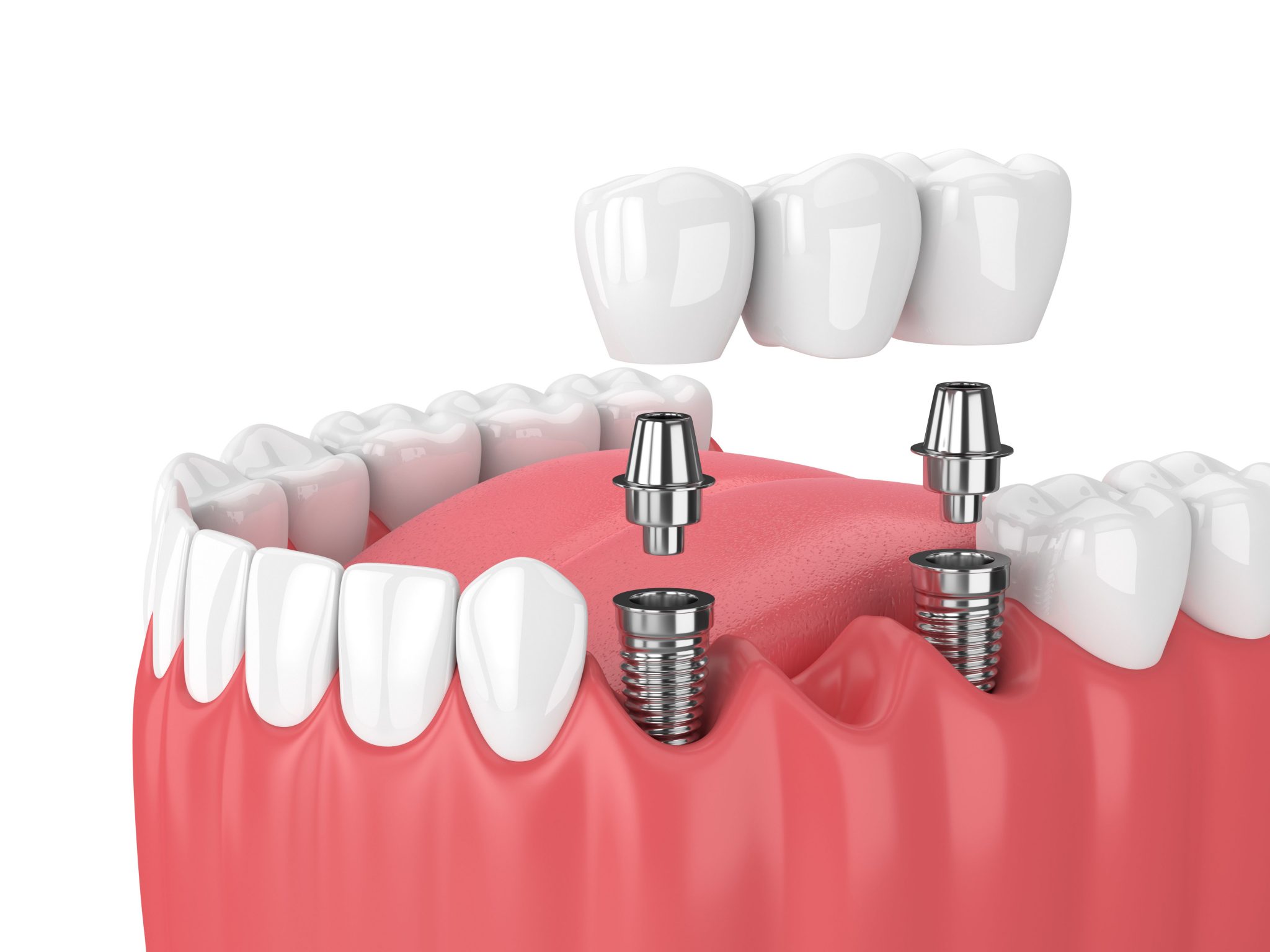 Dental Implant Benefits